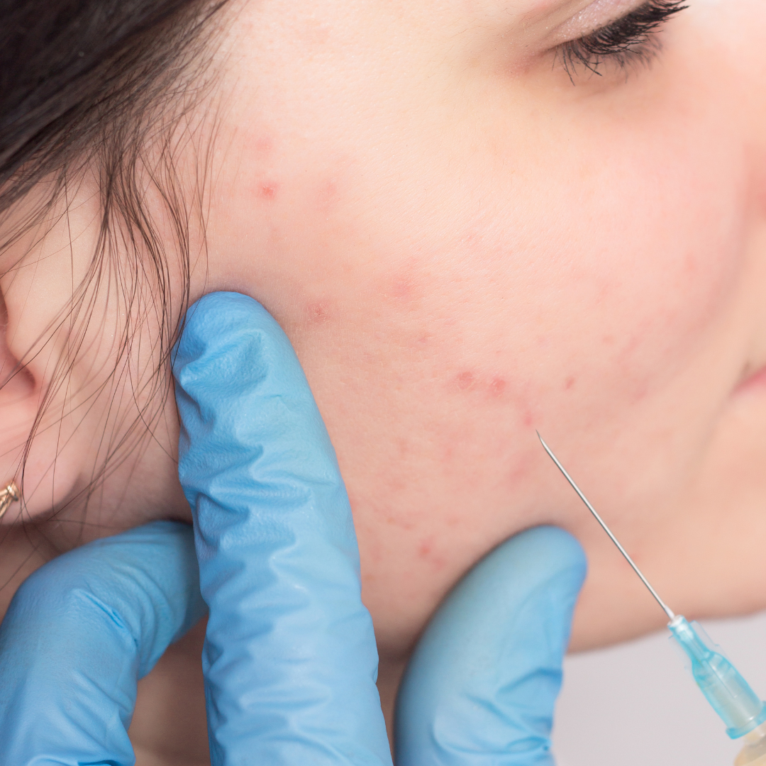 Acne Injections – Nature Derma™